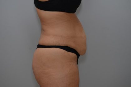 Abdominoplasty Before & After Patient #3158