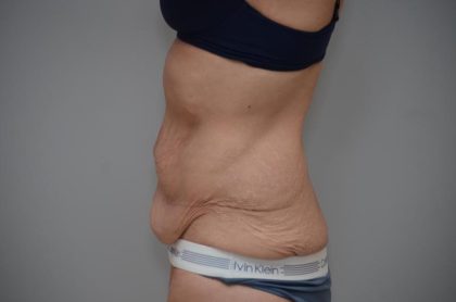 Body Lift Before & After Patient #3179