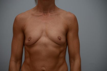 Breast Augmentation Before & After Patient #3180