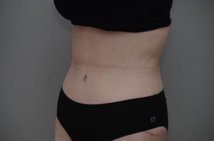 Body Lift Before & After Patient #3181