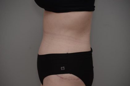 Body Lift Before & After Patient #3181