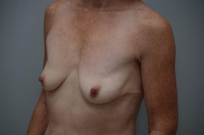 Breast Lift With Implants Before & After Patient #3182