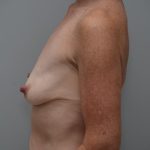 Breast Lift With Implants Before & After Patient #3182