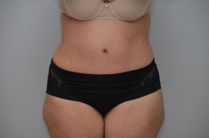 Abdominoplasty Before & After Patient #3185