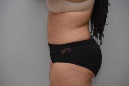 Abdominoplasty Before & After Patient #3185