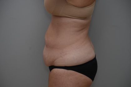 Abdominoplasty Before & After Patient #3186