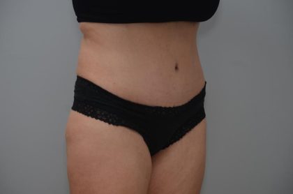 Abdominoplasty Before & After Patient #3188