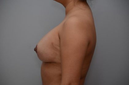Breast Augmentation Before & After Patient #3189