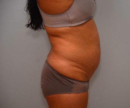 Abdominoplasty Before & After Patient #3190