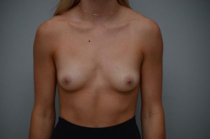 Breast Augmentation Before & After Patient #3191