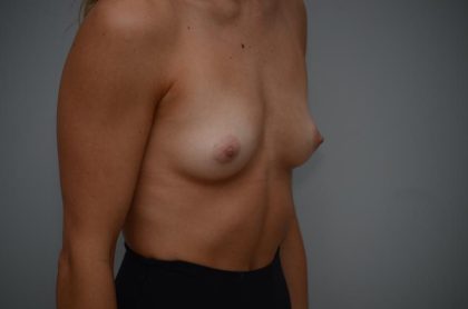 Breast Augmentation Before & After Patient #3191