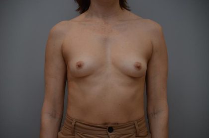 Breast Augmentation Before & After Patient #3192