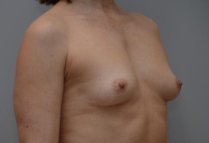 Breast Augmentation Before & After Patient #3192