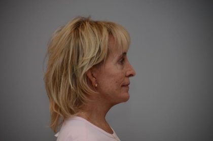 Facelift Before & After Patient #3193
