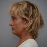 Facelift Before & After Patient #3193