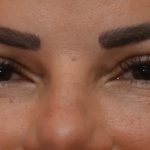 Blepharoplasty Before & After Patient #3194